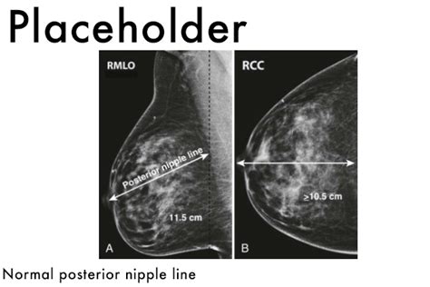 posterior nipple line radiology